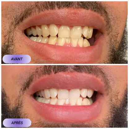 ✨ VEELANOO™ Smile Patches – Instant Teeth Whitening